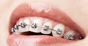 Imagen Brackets de metal