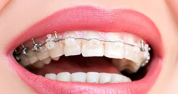 Imagen Brackets de zafiro